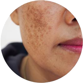 beneficio-melasma-2